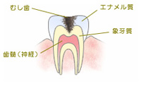 C2 内部の虫歯