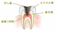 C3 歯の根の虫歯