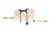 C4 末期の虫歯